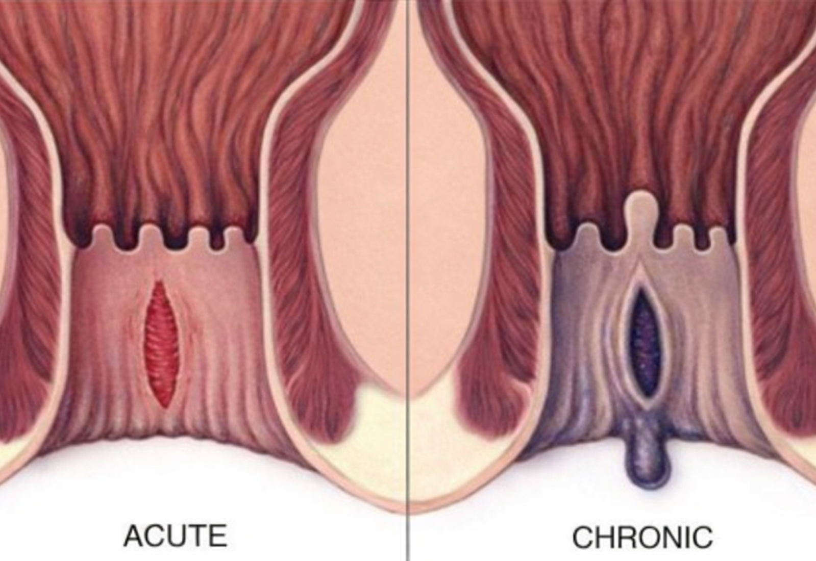 Acute vs chronic anal fissure