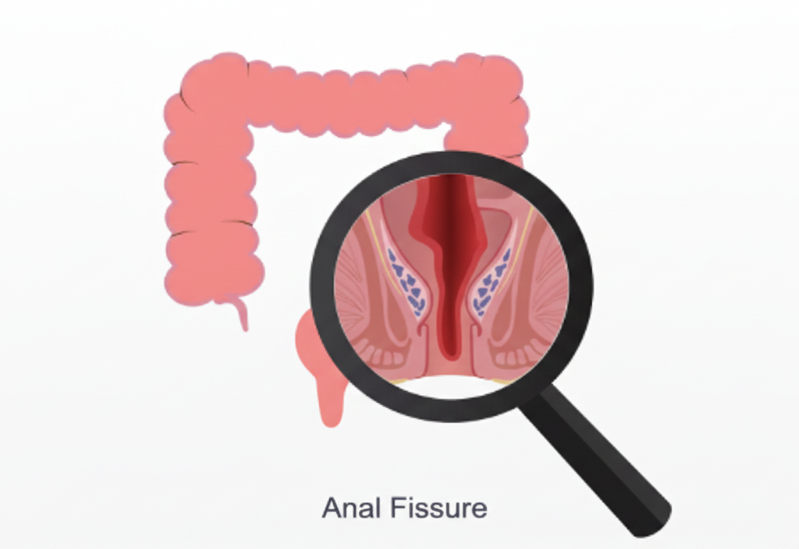Anal fissure symptoms and evaluation