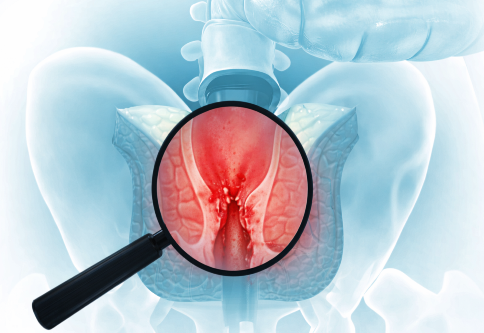 Anal fissure causes and triggers