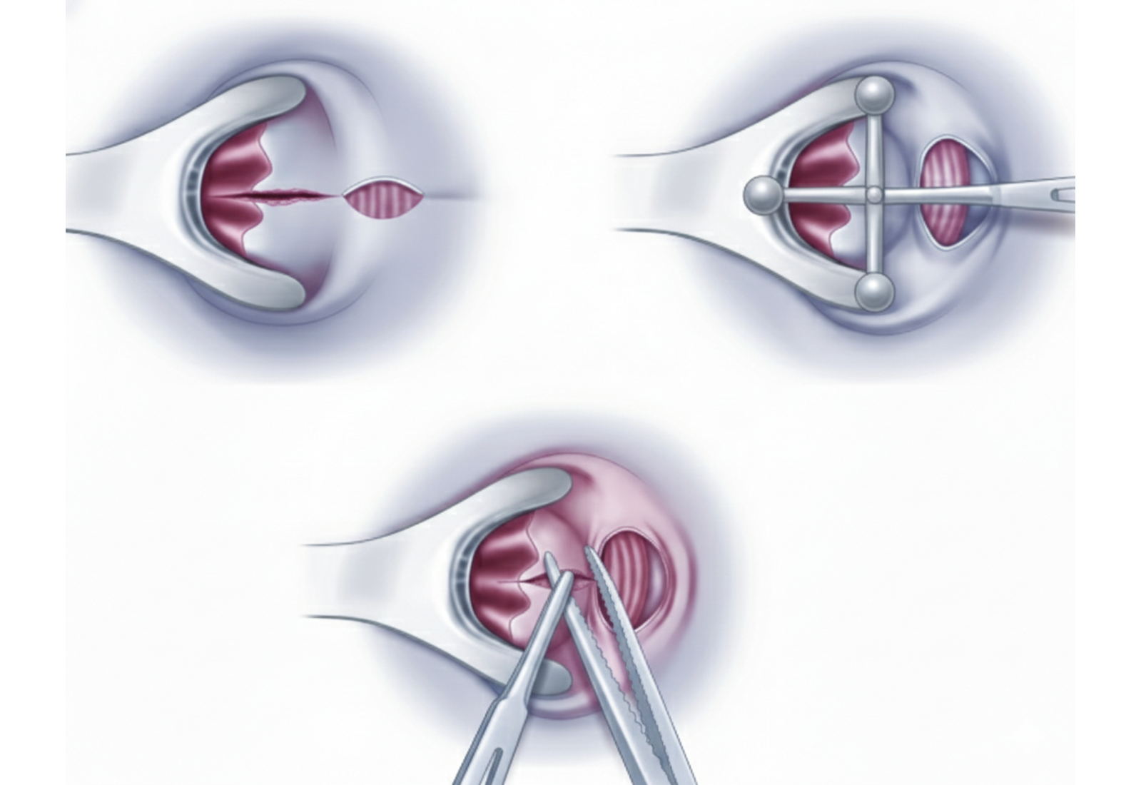 Anal fissure treatment options
