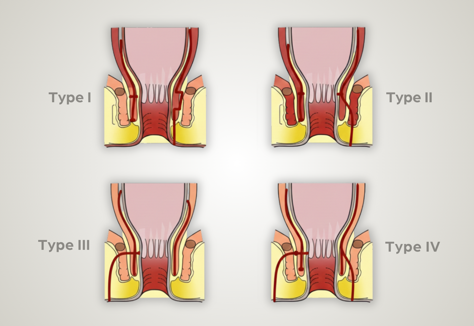 Anal fistula types and tracts