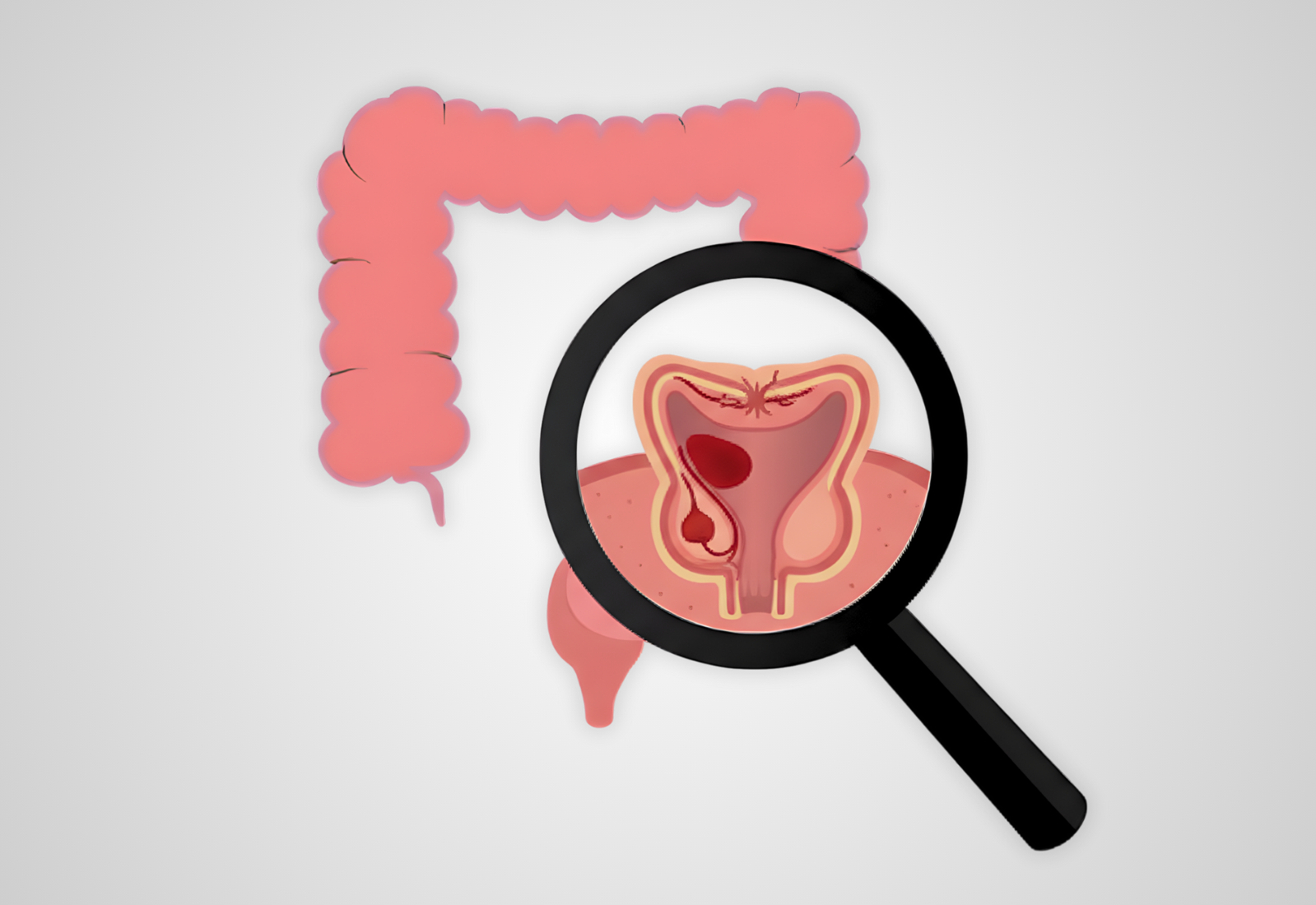 Anal fistula symptoms and evaluation