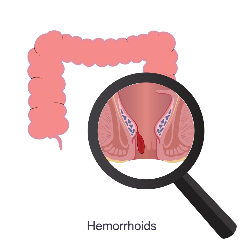 Piles evaluation and symptoms