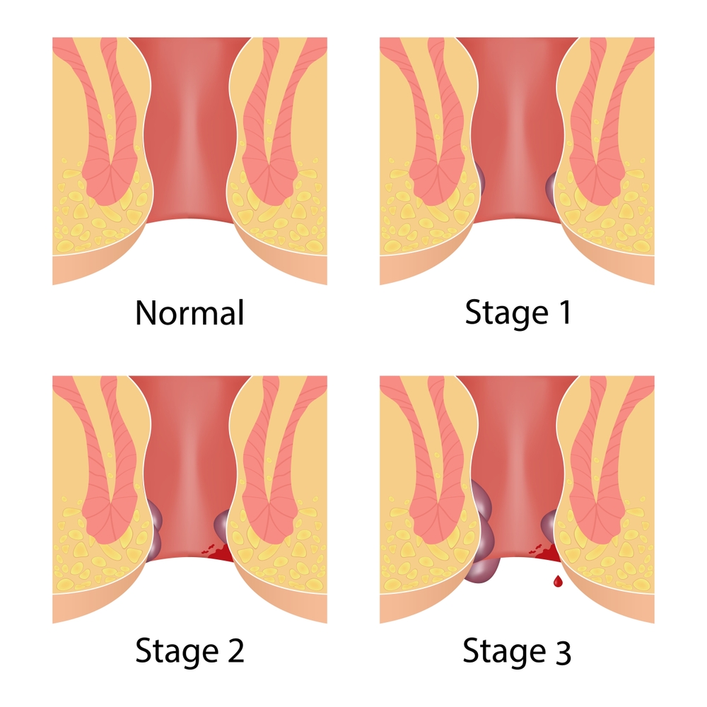 Piles grades (internal hemorrhoids)